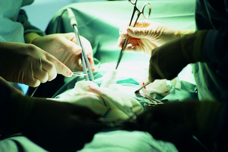 augmentation chirurgicale de l'épaisseur du pénis